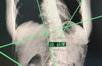 什么！脊柱矯正還能長(zhǎng)高？